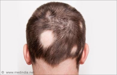 Image result for ringworm hair loss causes, symptoms & treatments
