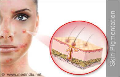 Skin Pigmentation Disorders | definition of Skin ...