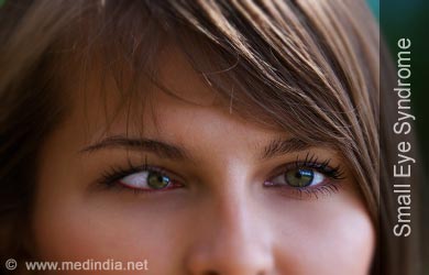 Small Eye Syndrome | Microphthalmia