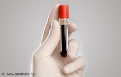 Are there blood tests for arthritis?