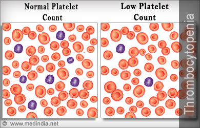low platelet count in blood test