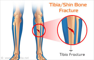 Tibia (Shinbone) Shaft Fractures - Causes, Symptoms ...