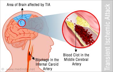 What is a Transient Ischemic Attack (TIA)?