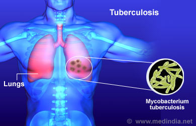 Vinegar kills tuberculosis and other mycobacteria