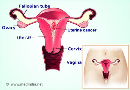 What is the survival rate of uterine cancer?
