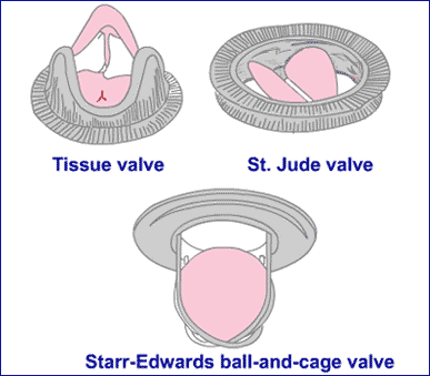 Mitral Valve replacement like valve repair is an open-heart procedure where 