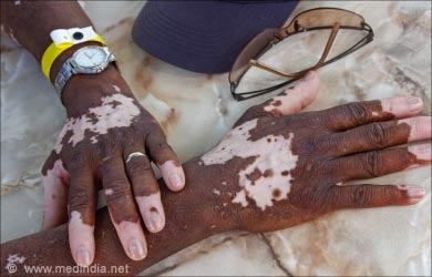 Dark Skin Tones and Skin Cancer: What You Need to Know ...