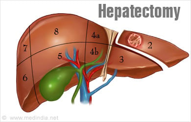 Hepatectomy Pictures 66