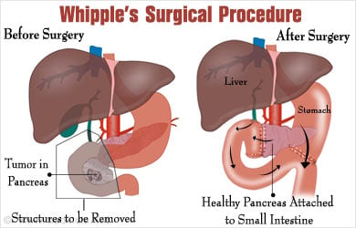 Whipple’s disease Symptoms and Treatment – Mediologiest