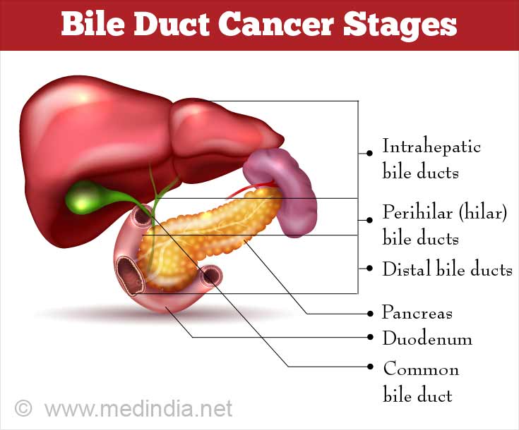 Bile Duct Cancer Stages