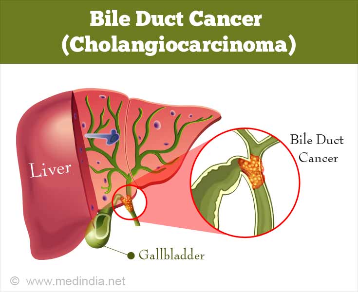 Bile Duct Cancer/Cholangiocarcinoma