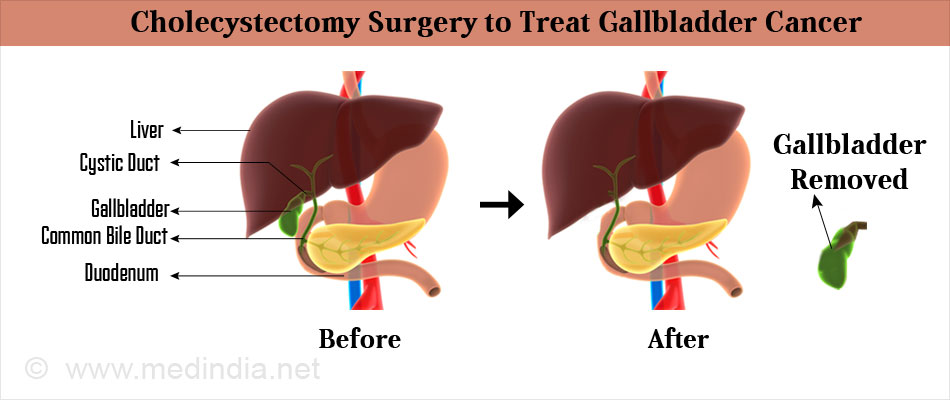 Cholecystectomy Surgery to Treat Gallbladder Cancer