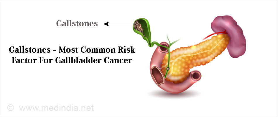 Gallstones - Most Common Risk Factor For Gallbladder Cancer