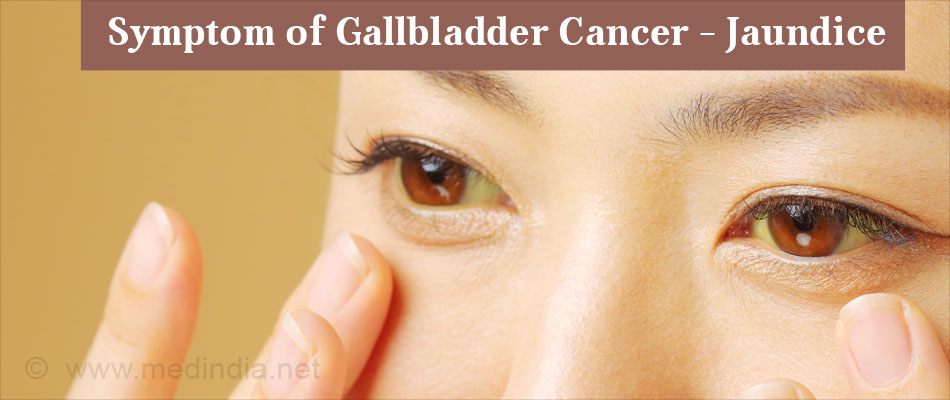 Symptom of Gallbladder Cancer - Jaundice