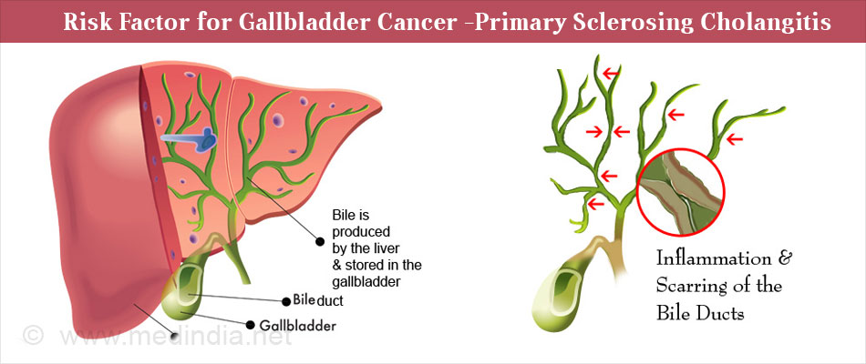 Risk Factor for Gallbladder Cancer - Primary Sclerosing Cholangitis