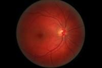 Diabetic Retinopathy Possibly Treated With Same Drugs As For AMD Diabetic Retinopathy Possibly Treated With Same Drugs As For AMD