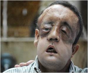 First Canadian Guideline for Bell's Palsy