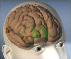  New Hope for Parkinson's Patients-A High Tech Brain Implant