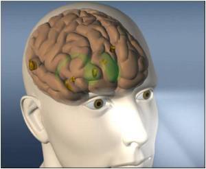  Adrenal Gland Hormone Linked to Brain Hypertension