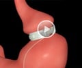 Bariatric Surgery - 3D Animation on Gastric Band Procedure