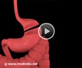 Bariatric Surgery - Gastric Bypass Procedure