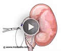 Pyeloplasty of Kidney