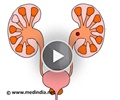 Kidney Stones - Animation