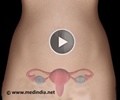 Removal of Ovaries - Oophorectomy