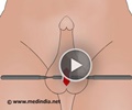 Orchidectomy