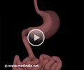 Weight Loss Surgery - Sleeve Gastrectomy