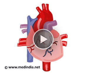 Animation of heart attack symptoms