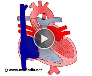 Patent Ductus Arteriosus