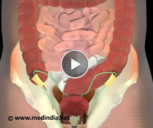 Inguinal Hernia Animation - Cause and Symptoms