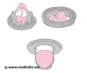 Mitral Valve Disease and Replacement