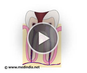 Root Canal Treatment