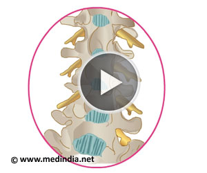 Spinal or Epidural anesthesia