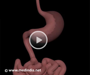 Weight Loss Surgery - Sleeve Gastrectomy