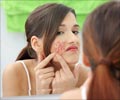Pimples and Acne - Beauty Tips