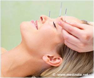 Acupuncture can Treat Migraines