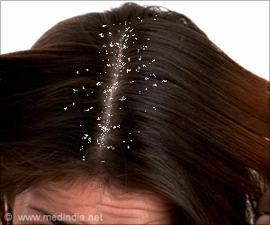 Simple Tips to Get Rid of Dandruff in a Natural Way