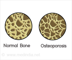 Effectiveness of Osteoporosis Drugs Tested!