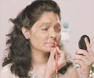 Concentrated Acid is Easier to Get As Beauty Products in India: Bold Acid Attack Survivor Concentrated Acid is Easier to Get As Beauty Products in India: Bold Acid Attack Survivor