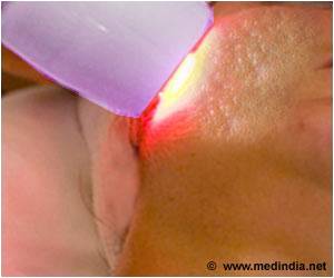 Laser Treatment Improves Color and Texture of Acne Scars