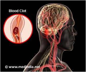 Ischemic Stroke: New Molecule Provides Protective Effect