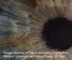 Artificial Intelligence to Speed Up Diagnosis of Eye Diseases