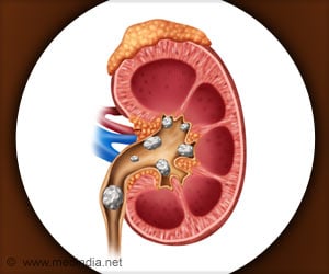 Alpha-lipoic Acid Prevents Kidney Stones in Rare Genetic Disease