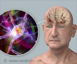 Lecanemab's Surge: Alzheimer's Breakthrough Amid Gender Concerns