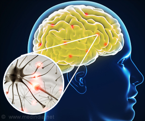  The MITOS System Predicts Long-Term Survival in Amyotrophic Lateral Sclerosis (ALS)