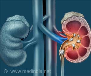 Oral Antibiotics Linked to Increase in Kidney Stones Risk