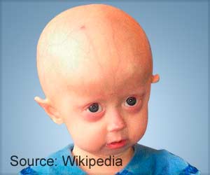 Blood Vessel Model Developed for Screening Drugs for Progeria